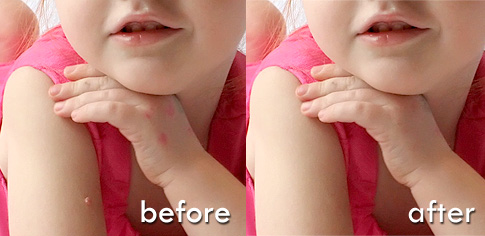 Fixing Blemishes on skin